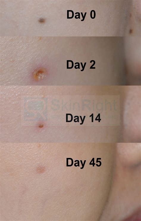 mole removal healing stages pictures